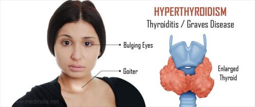 Symptoms of an overactive thyroid