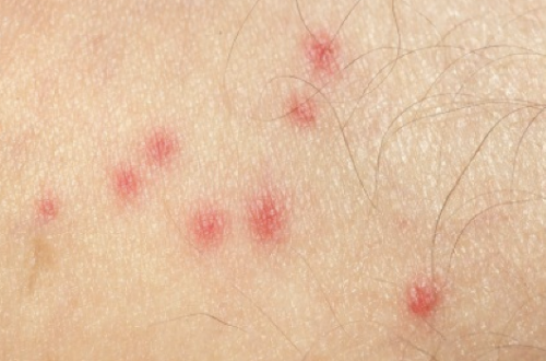 دانههای قرمز روی پوست کودکان