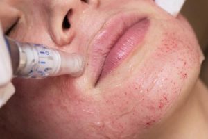 میکرونیدلینگ چیست و چه کاربردها و عوارضی دارد؟