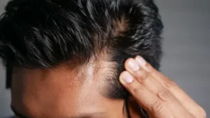 اگزوزم مو چیست و چه تاثیری در درمان ریزش مو دارد؟